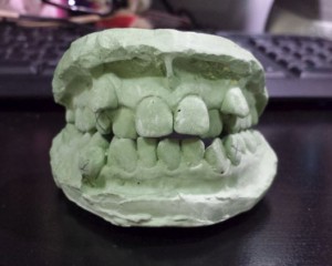 My teeth 3 years ago - vampire mode on!